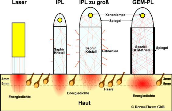 Laser IPL GEM Vergleich